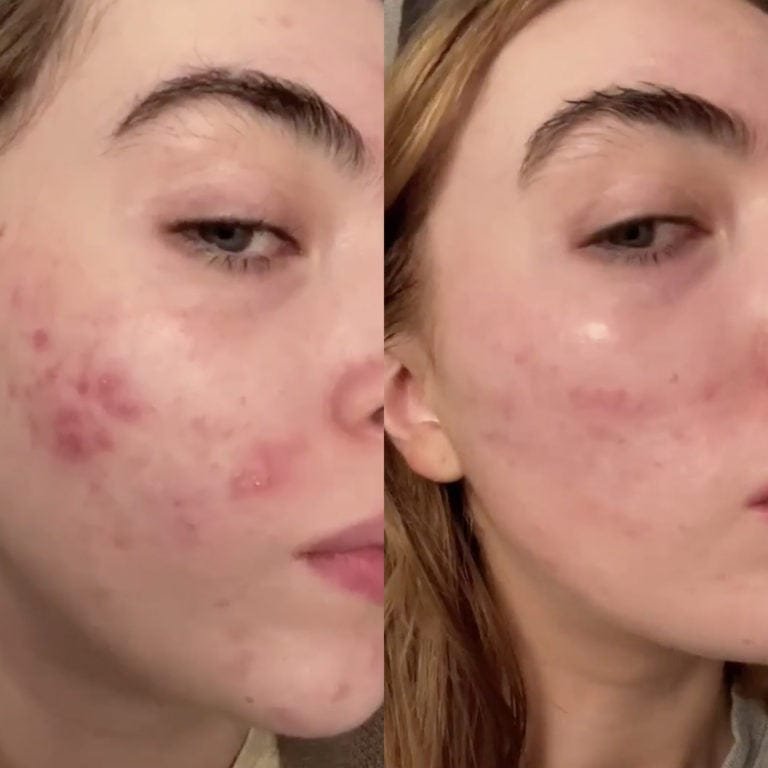Side-by-side comparison of a woman’s face showing acne before and after skincare treatment.