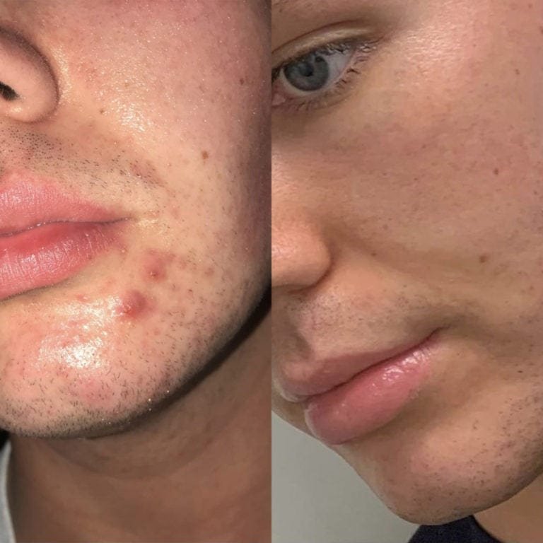 Side-by-side comparison of a man’s skin before and after using skincare, showing a reduction in acne and improved skin texture