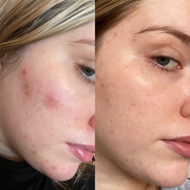 Side-by-side before-and-after image showing improved skin clarity and reduced redness.